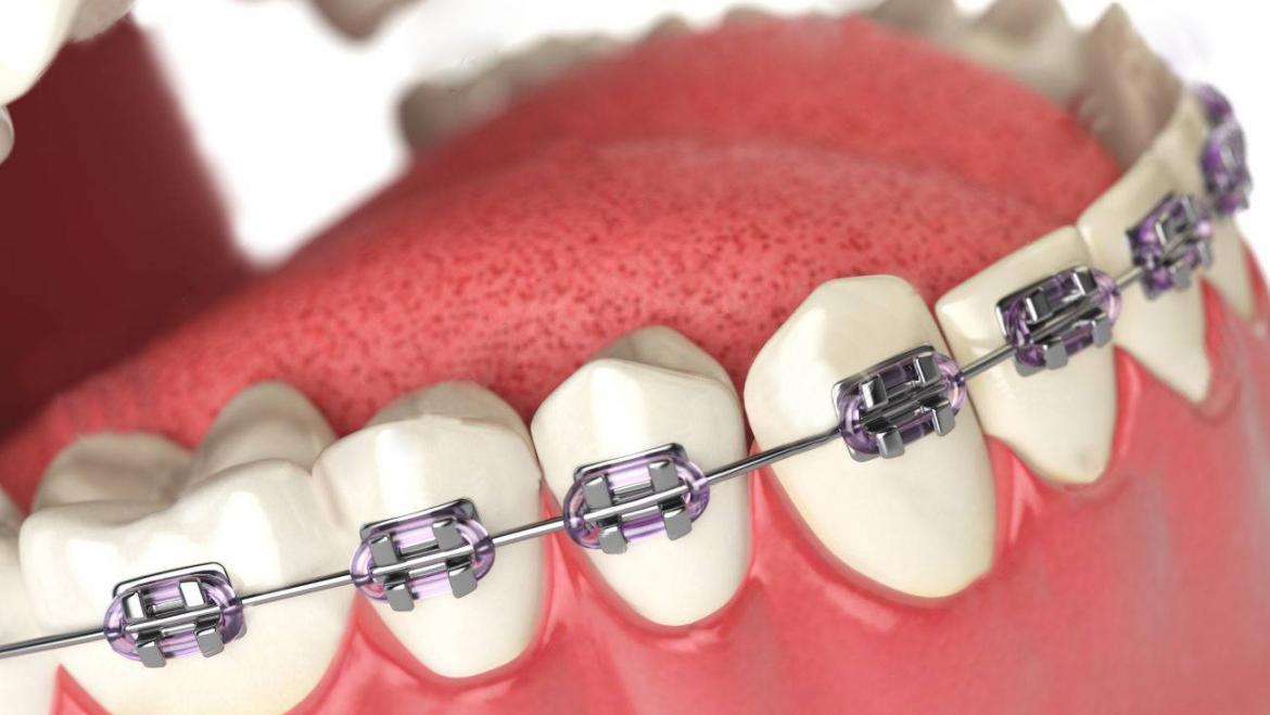 Dental Braces