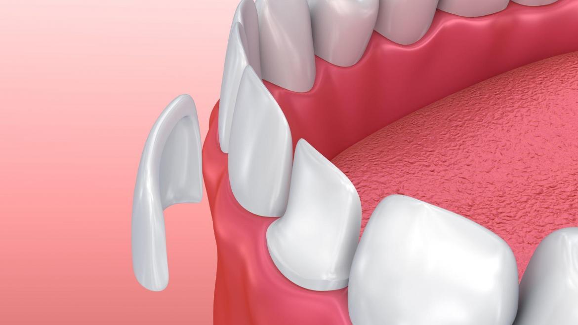 Veneers
